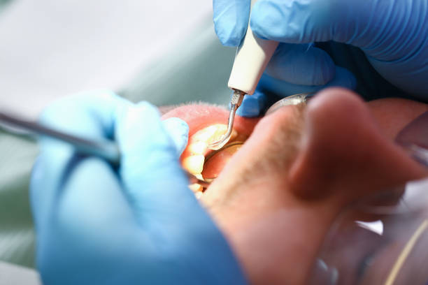 Best Chipped Tooth Repair Near Me  in Unionville, MO